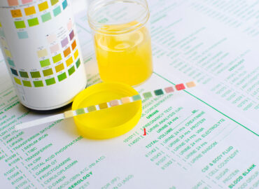 Urine Analysis Testing